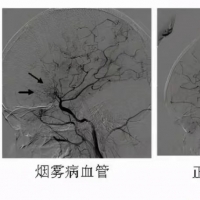 “河南經(jīng)驗(yàn)”寫入最新煙霧病中國(guó)專家共識(shí)